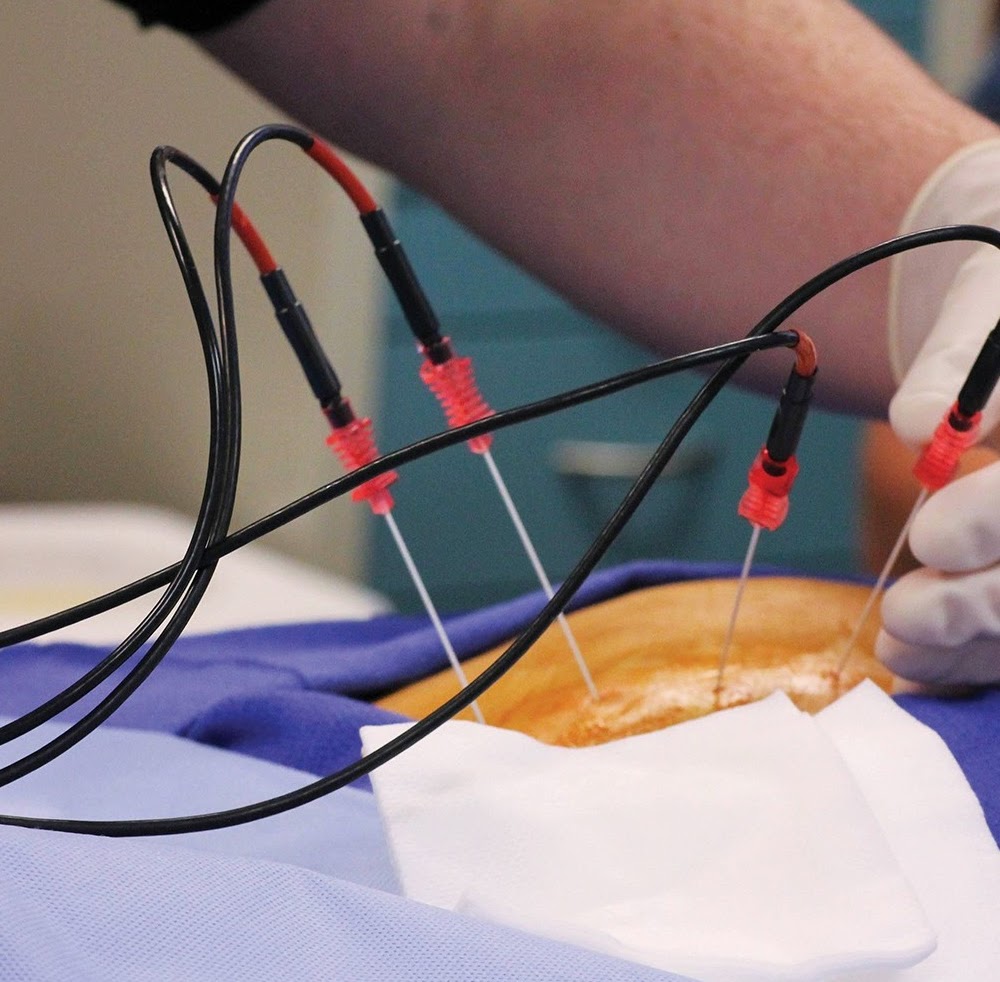 التدخلات المحدوده لعلاج ألم العمود الفقرى و عرق النسا