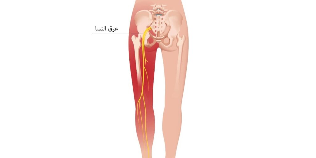 عرق النسا و علاجه