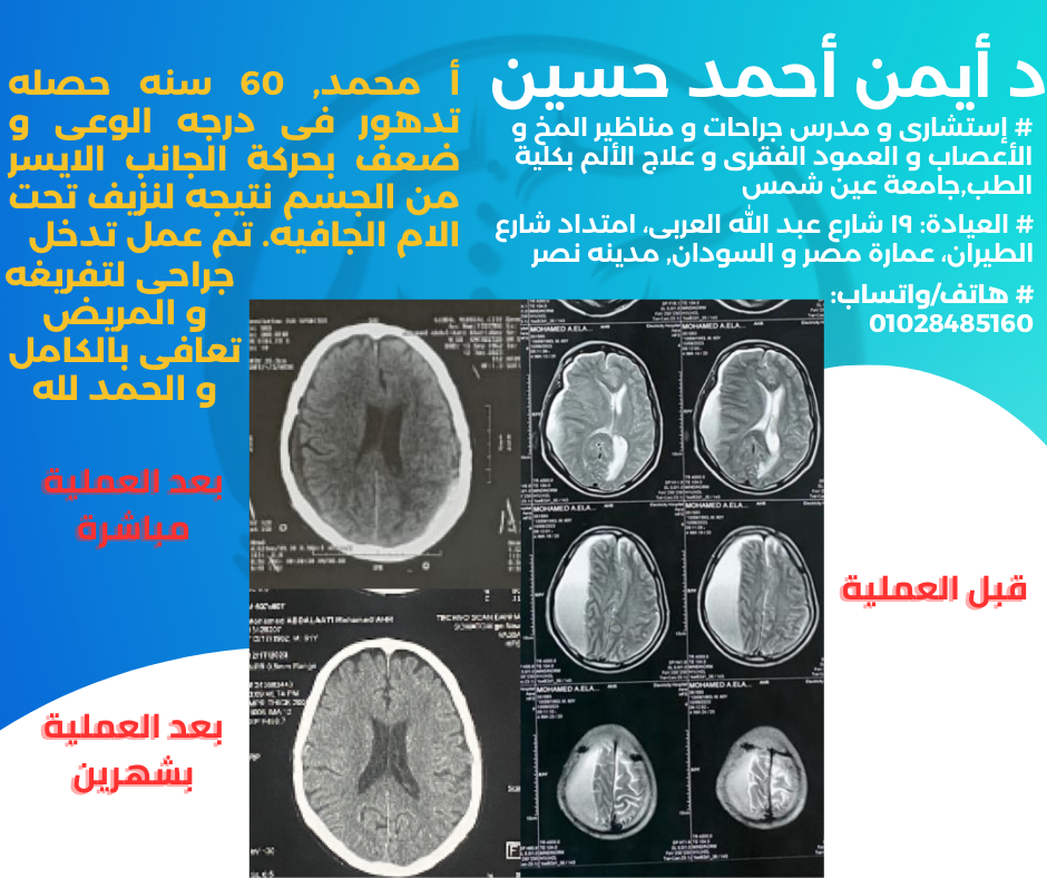 تفريغ نزيف مزمن تحت الأم الجافيه بالمخ