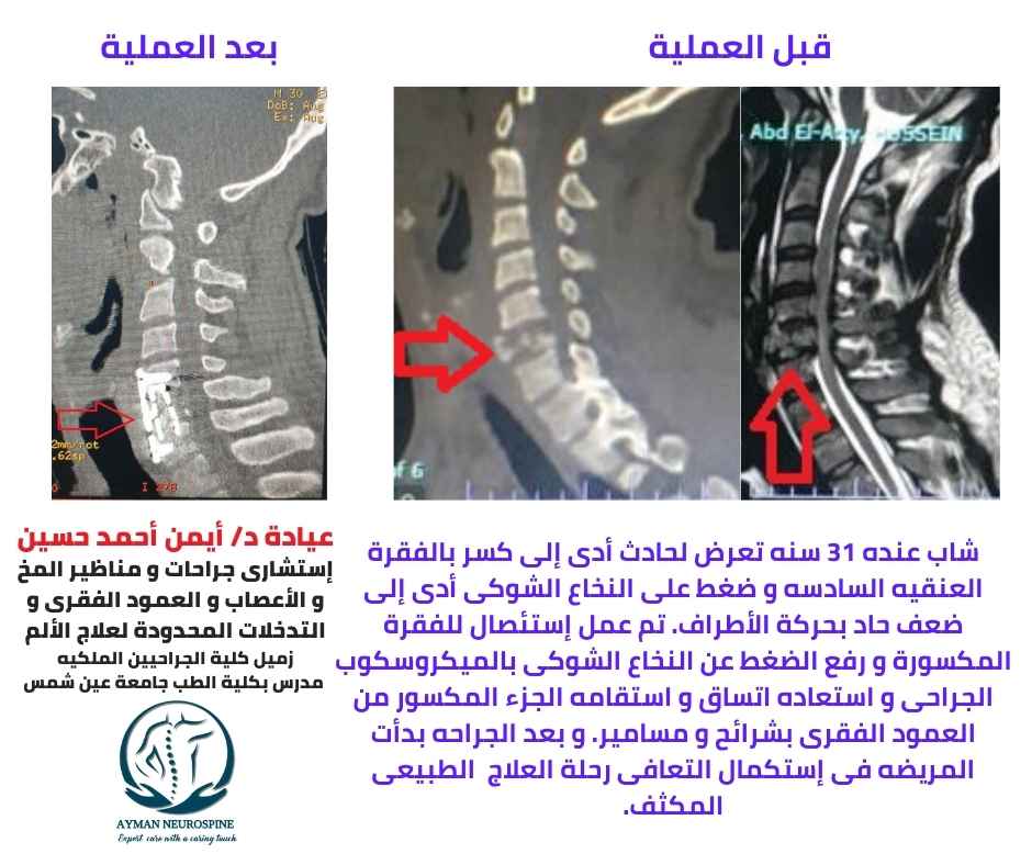 تثبيت جراحى لكسر بالفقرات العنقيه