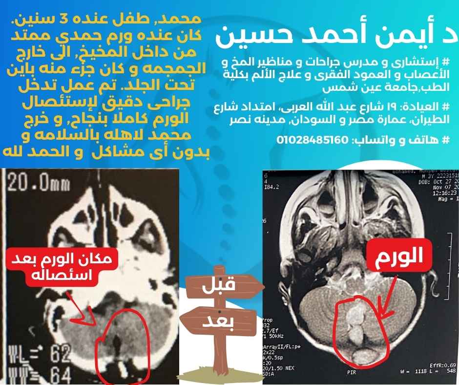 إستئصال أورام المخ بالأطفال