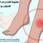 سقوط القدم بعد التخدير النصفى