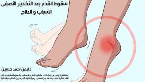 سقوط القدم بعد التخدير النصفى