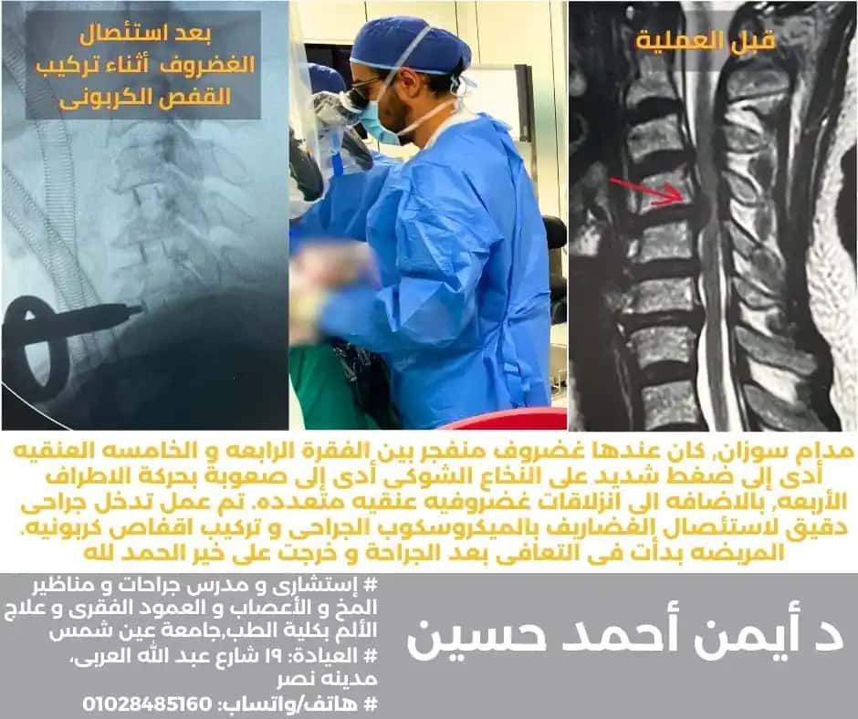 استئصال انزلاق غضروفى عنقى بالميكروسكوب الجراحى