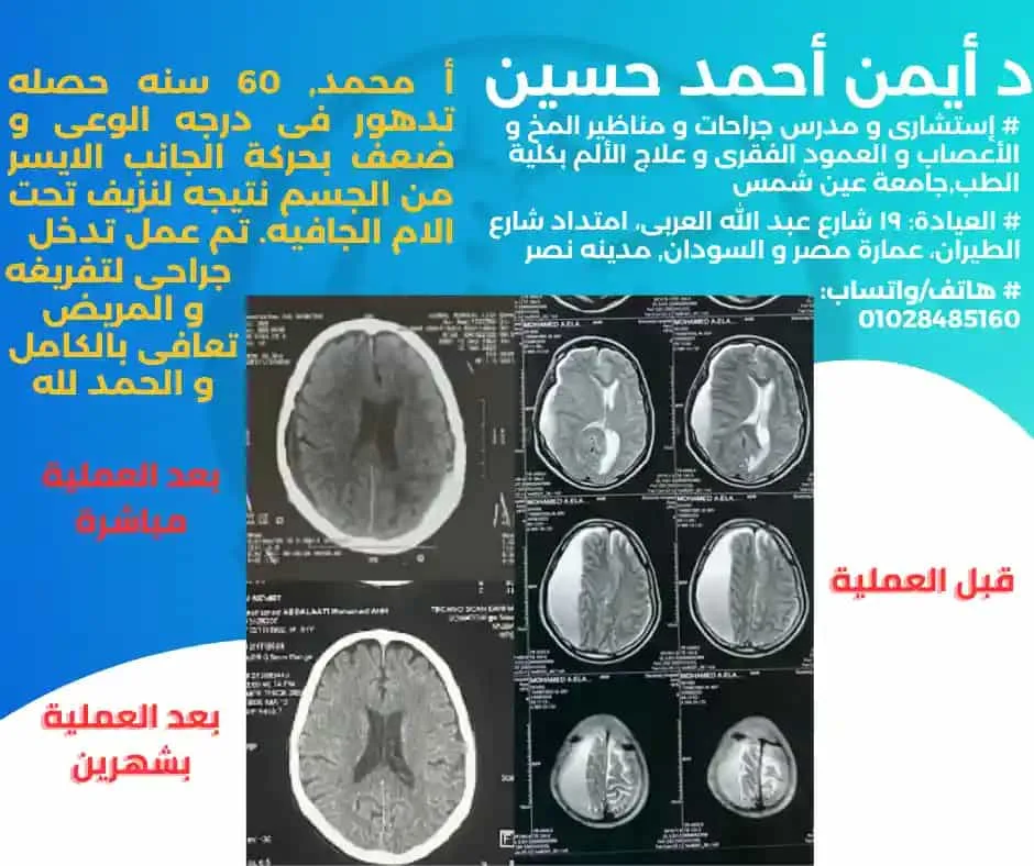 تفريغ نزيف مزمن تحت الأم الجافيه