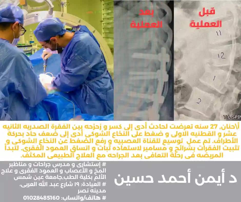 تثبيت الفقرات بشرائح و مسامير - كسر بالعمود الفقرى