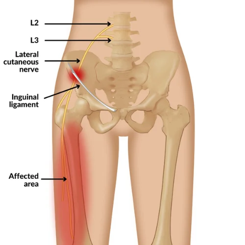 حرقان الفخذ
