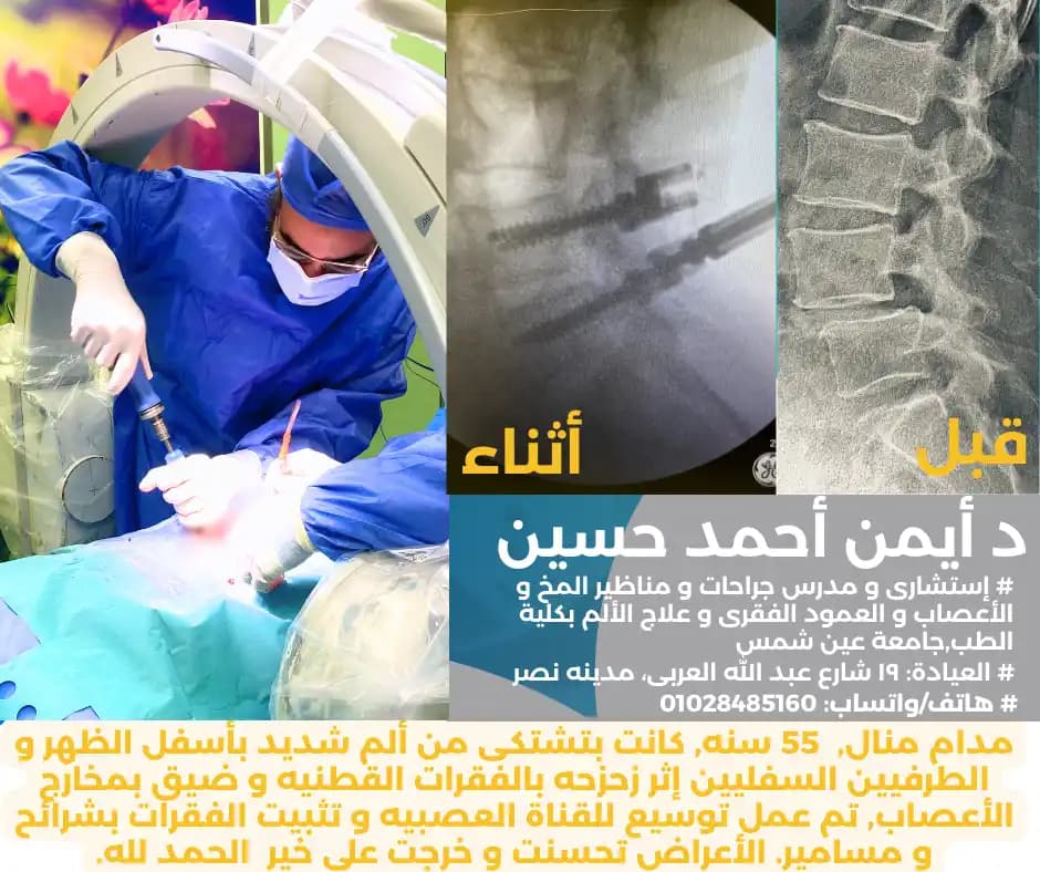 تثبيت فقرات قطنيه بشرائح و مسامير - زحزحه بالفقرات القطنيه